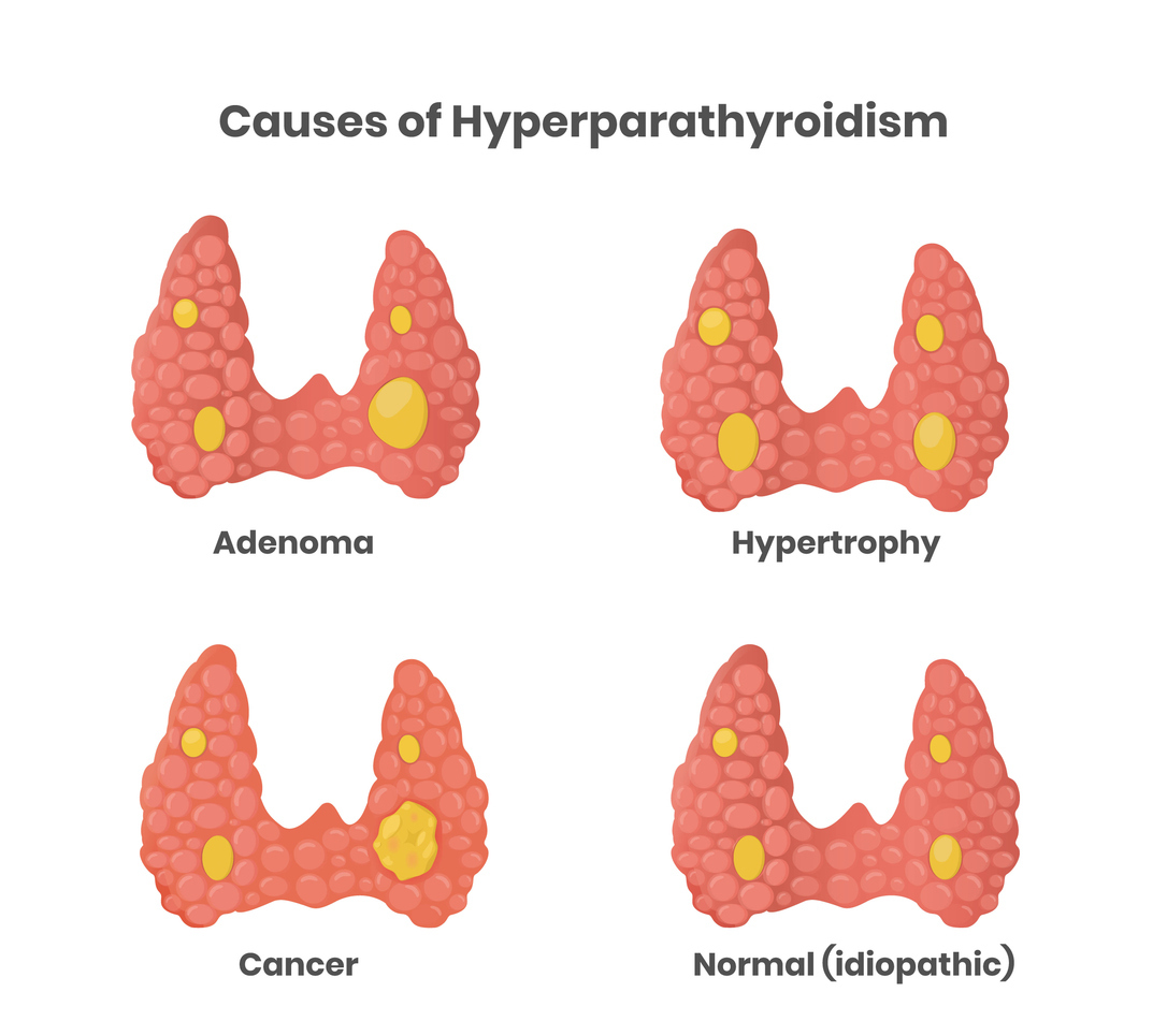 Common causes of Hyperparathyroidism include adenoma, hypertrophy, and cancer
