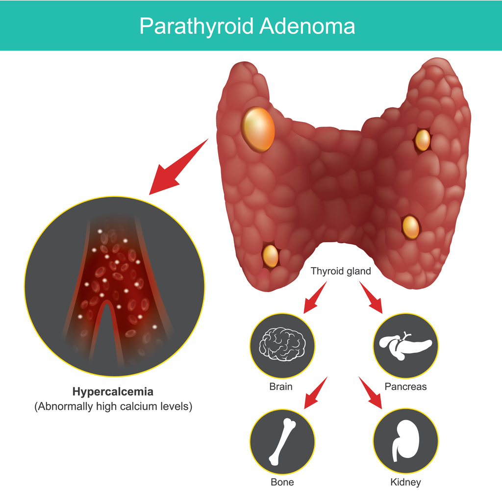 Parathyroid Adenoma affects the brain, pancreas, bones, and kidneys